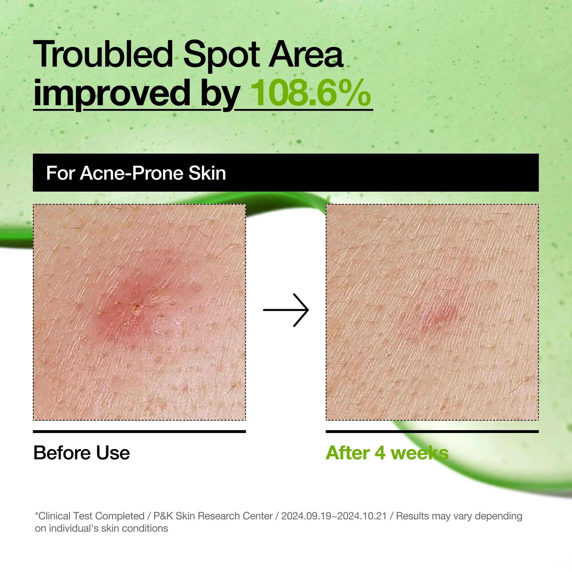 Anua Azelaic Acid 10 Hyaluron Redness Soothing Serum 30ml/1.01oz - Image 7