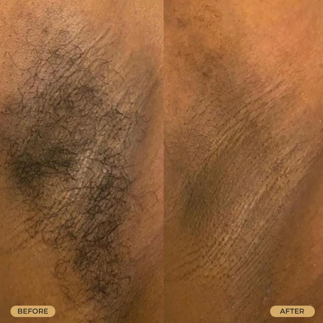 Skin Tight Ultimate Skin Care for Razor Bumps 118ml/4oz - Image 6